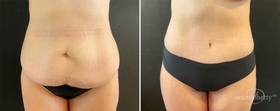 Tummy Tuck Before and After Photos in Boston, MA, Patient 11923