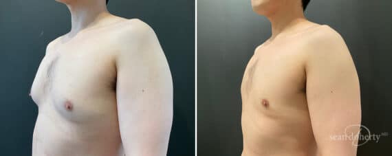 Gynecomastia Before and After Photos in Boston, MA, Patient 11942