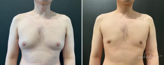Gynecomastia Before and After Photos in Boston, MA, Patient 11942
