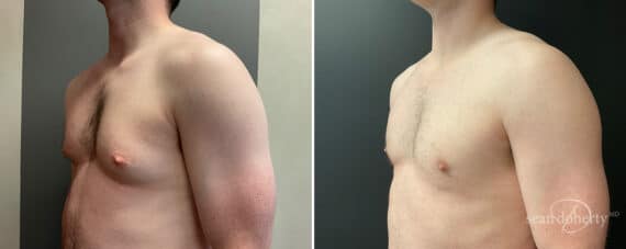 Gynecomastia Before and After Photos in Boston, MA, Patient 11990