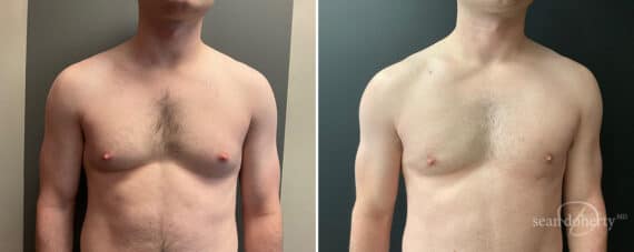 Gynecomastia Before and After Photos in Boston, MA, Patient 11990