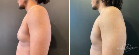 Gynecomastia Before and After Photos in Boston, MA, Patient 12000