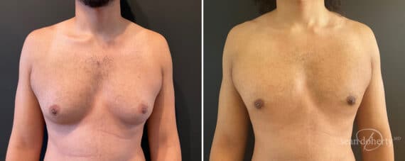 Gynecomastia Before and After Photos in Boston, MA, Patient 12000