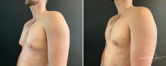 Gynecomastia Before and After Photos in Boston, MA, Patient 12005