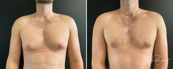 Gynecomastia Before and After Photos in Boston, MA, Patient 12005