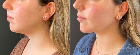 Liposuction Before and After Photos in Boston, MA, Patient 12097