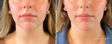 Liposuction Before and After Photos in Boston, MA, Patient 12097