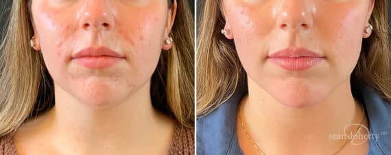 Liposuction Before and After Photos in Boston, MA, Patient 12097