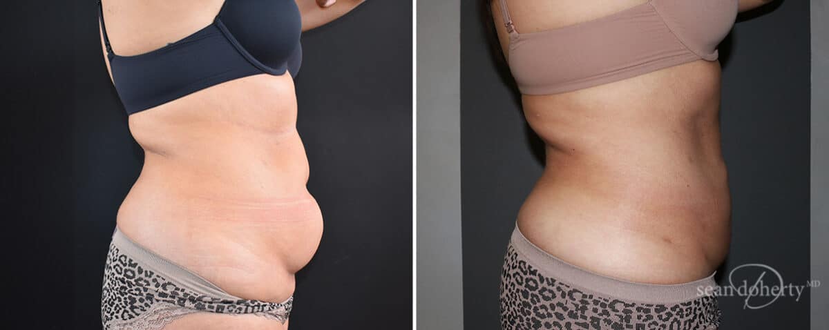 Patient 12102, Liposuction Before and After Photos Liposuction Before and After Photos in Boston, MA, Patient 12102