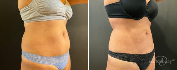 Liposuction Before and After Photos in Boston, MA, Patient 12107