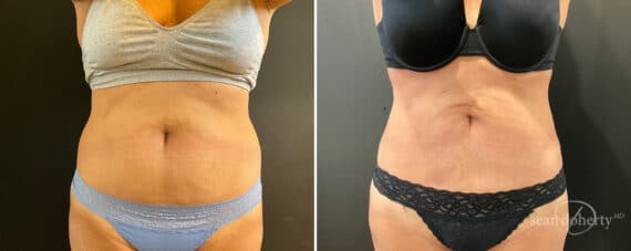 Liposuction Before and After Photos in Boston, MA, Patient 12107