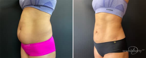 Liposuction Before and After Photos in Boston, MA, Patient 12112