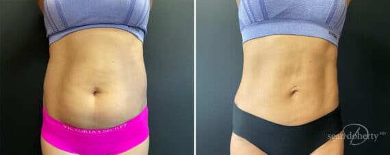 Liposuction Before and After Photos in Boston, MA, Patient 12112