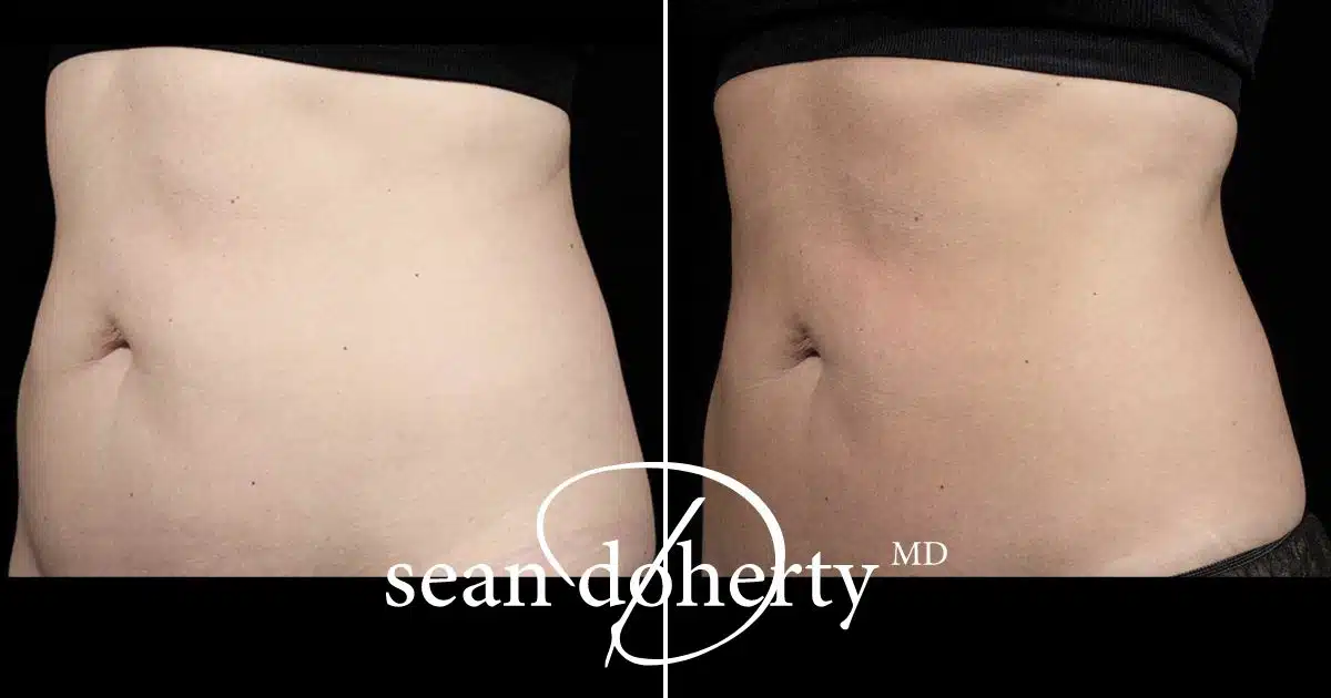 post semaglutide body contouring boston SculpSure Boston, MA