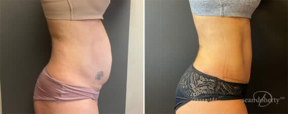 Tummy Tuck Before and After Photos in Boston, MA, Patient 11937