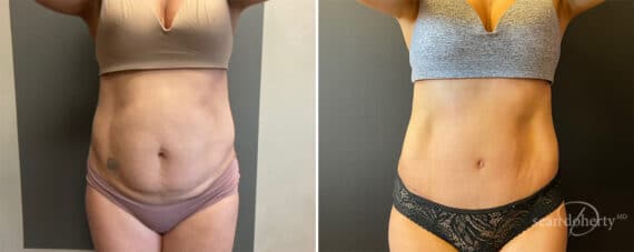 Tummy Tuck Before and After Photos in Boston, MA, Patient 11937
