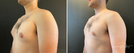 Gynecomastia Before and After Photos in Boston, MA, Patient 11995