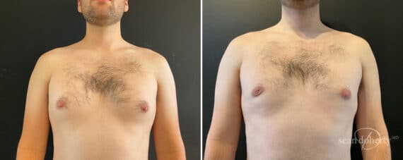 Gynecomastia Before and After Photos in Boston, MA, Patient 11995