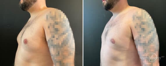 Gynecomastia Before and After Photos in Boston, MA, Patient 12010