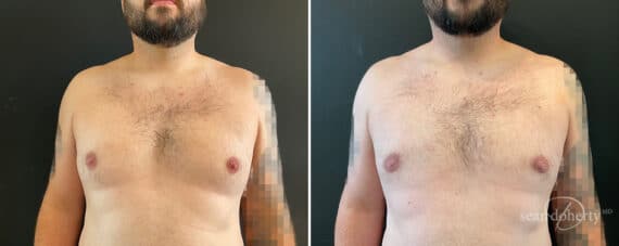 Gynecomastia Before and After Photos in Boston, MA, Patient 12010