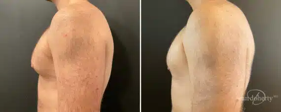 Gynecomastia Before and After Photos in Boston, MA, Patient 12015