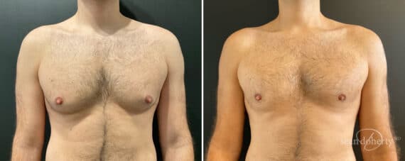 Gynecomastia Before and After Photos in Boston, MA, Patient 12015