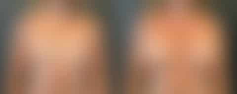 Breast Augmentation Before and After Photos in Boston, MA, Patient 12019