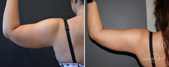 Liposuction Before and After Photos in Boston, MA, Patient 12053