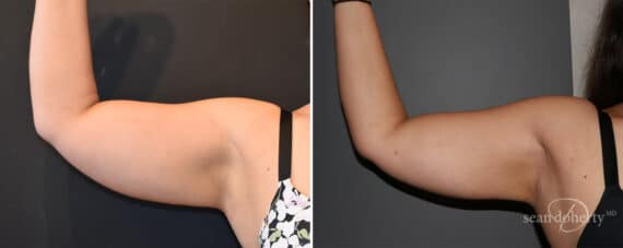 Liposuction Before and After Photos in Boston, MA, Patient 12053