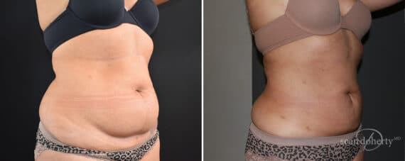 Liposuction Before and After Photos in Boston, MA, Patient 12102