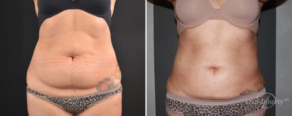 Liposuction Before and After Photos in Boston, MA, Patient 12102