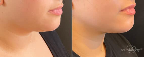 Liposuction Before and After Photos in Boston, MA, Patient 12122
