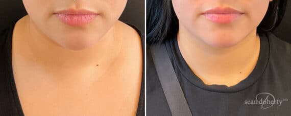 Liposuction Before and After Photos in Boston, MA, Patient 12122