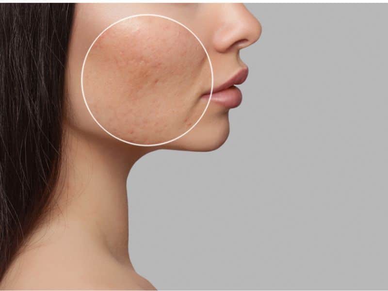 Close-up of a woman's cheek with improved skin tone and texture, highlighting benefits of Clear + Brilliant® and HydraFacial®.