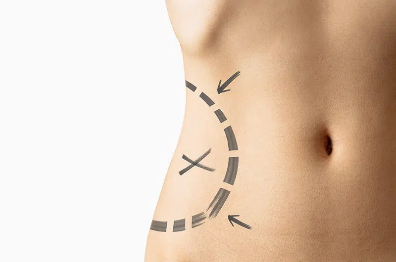 Liposuction is a surgical procedure that reshapes the body, giving you the body profile that you've always wanted. Dr, Sean Doherty | Boston, MA.