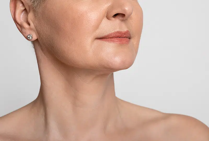 Female patient of Dr. Doherty's who underwent neck liposuction