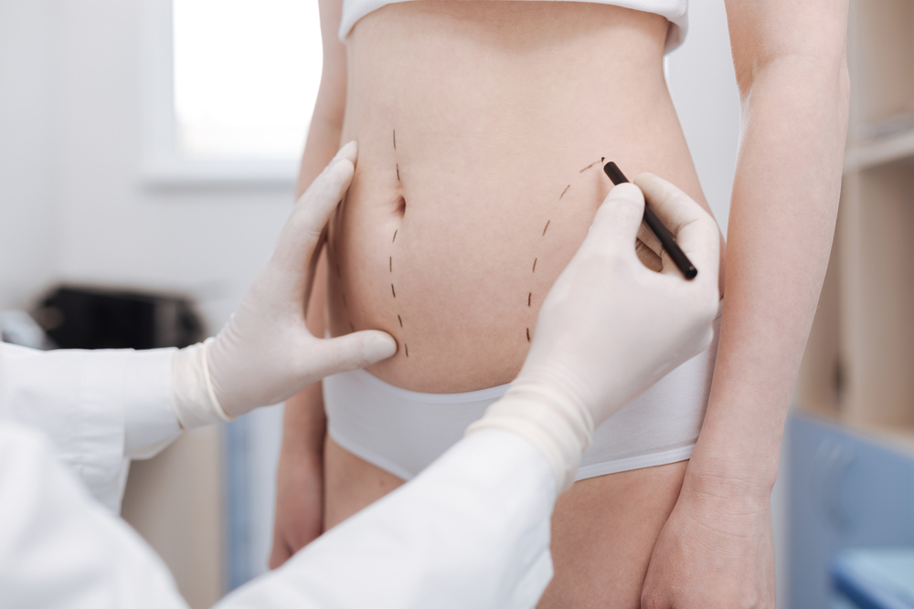 Surgeon marking abdominal area to evaluate candidacy for liposuction under local anesthesia.