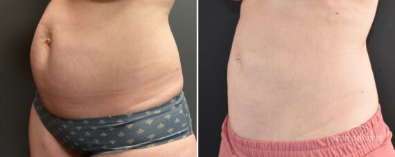 Liposuction Before and After Photos in Boston, MA, Patient 12117