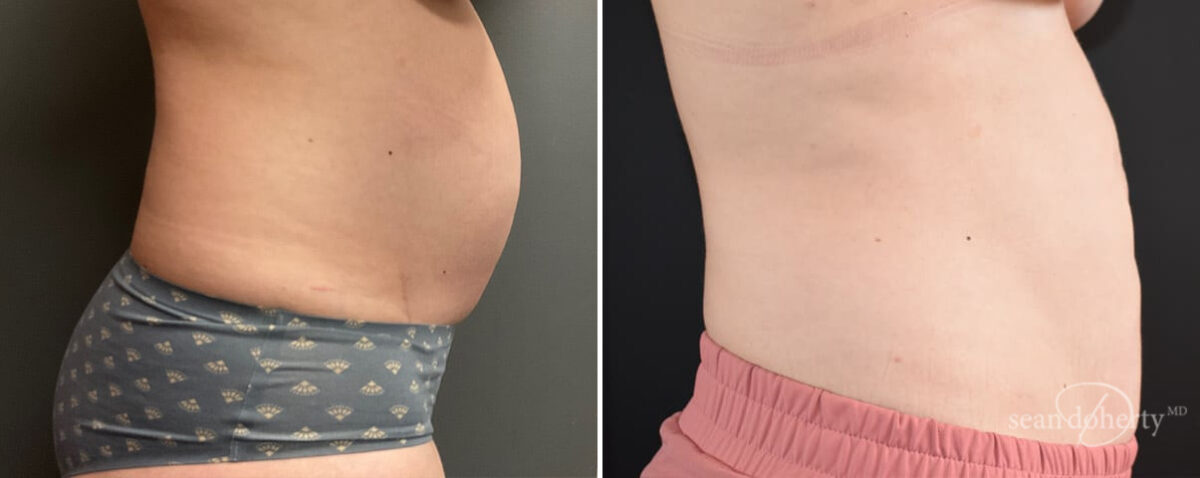 Patient 12117, Liposuction Before and After Photos Liposuction Before and After Photos in Boston, MA, Patient 12117