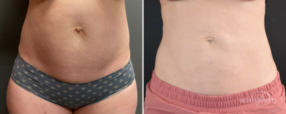 Liposuction Before and After Photos in Boston, MA, Patient 12117