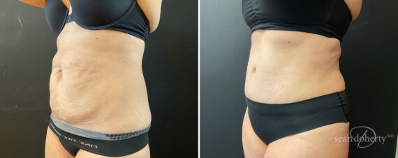 Tummy Tuck Before and After Photos in Boston, MA, Patient 13811