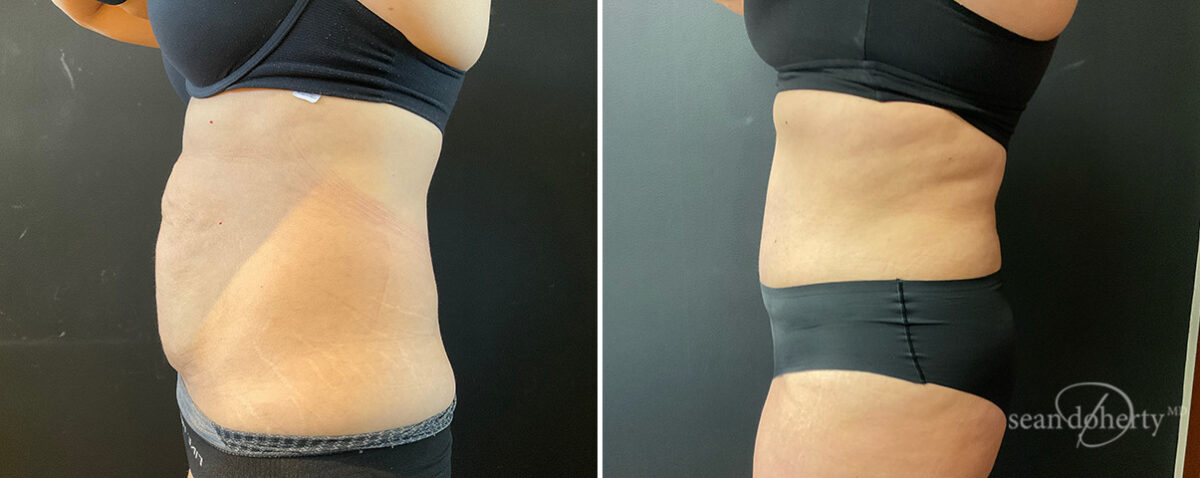 Patient 13811, Tummy Tuck Before and After Photos Tummy Tuck Before and After Photos in Boston, MA, Patient 13811