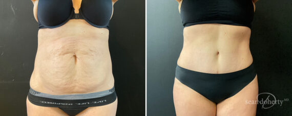 Tummy Tuck Before and After Photos in Boston, MA, Patient 13811