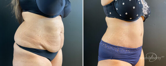 Tummy Tuck Before and After Photos in Boston, MA, Patient 13821