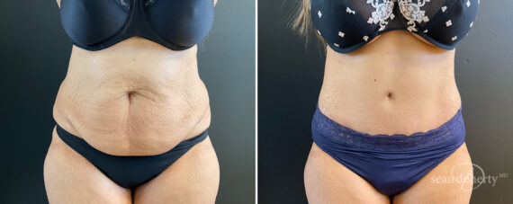 Tummy Tuck Before and After Photos in Boston, MA, Patient 13821
