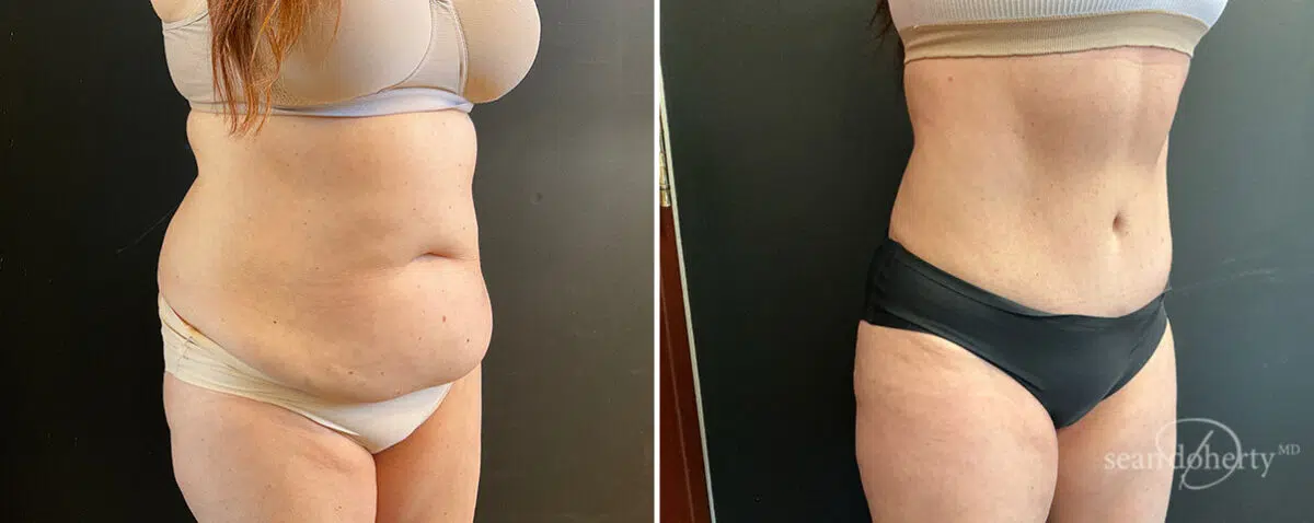 Patient 13831, Tummy Tuck Before and After Photos Tummy Tuck Before and After Photos in Boston, MA, Patient 13831