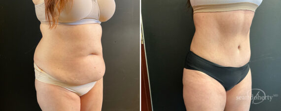 Tummy Tuck Before and After Photos in Boston, MA, Patient 13831