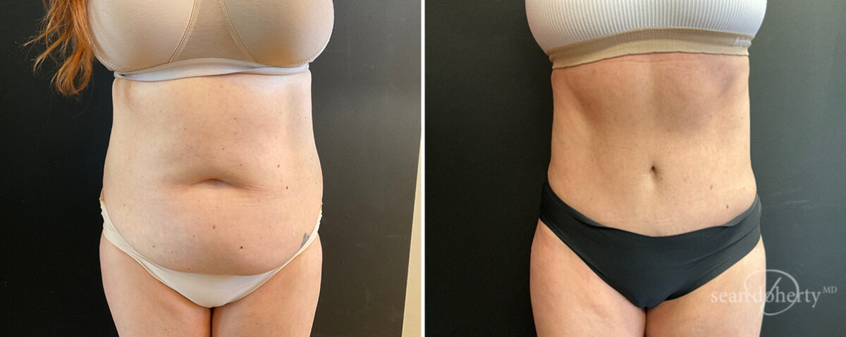Patient 13831, Tummy Tuck Before and After Photos Tummy Tuck Before and After Photos in Boston, MA, Patient 13831