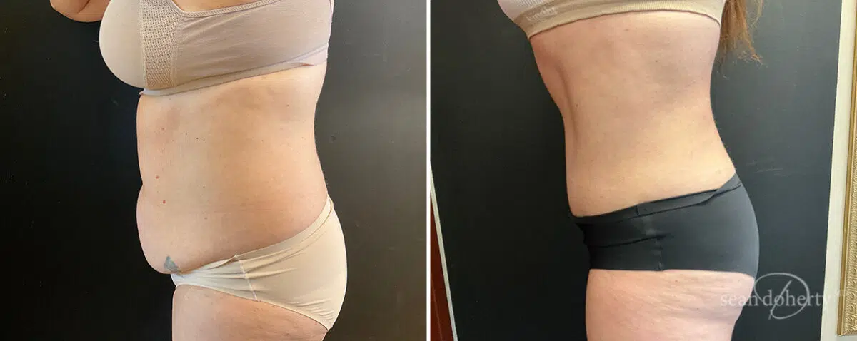 Patient 13831, Tummy Tuck Before and After Photos Tummy Tuck Before and After Photos in Boston, MA, Patient 13831