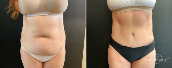 Tummy Tuck Before and After Photos in Boston, MA, Patient 13831